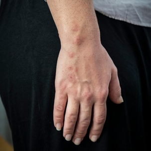 what do bed bug bites look like